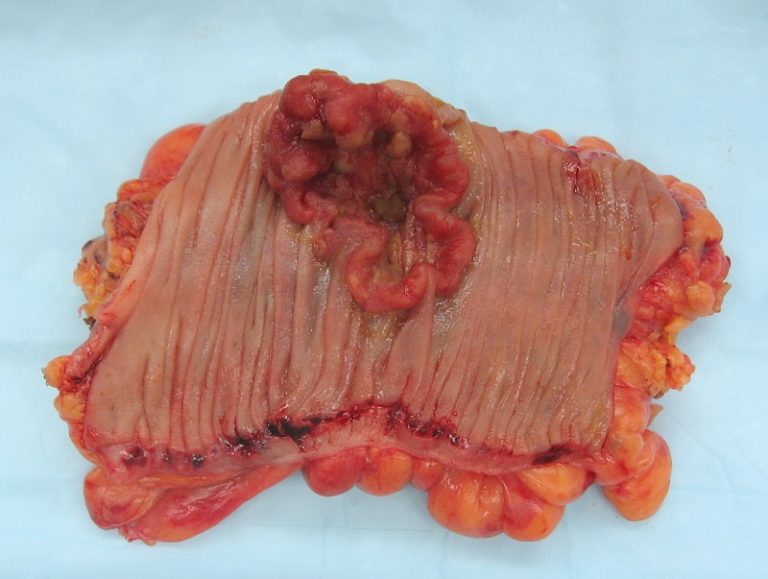 Colon_cancer_2
