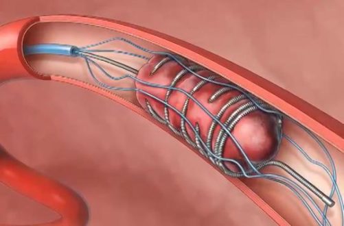 thrombectomie